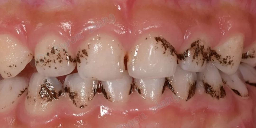 其实,如果没有认真清洁维护,牙齿表面不仅可能现白点,黑点,还有可能会