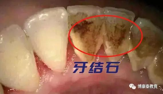 博康泰丨刷牙可以预防牙结石?