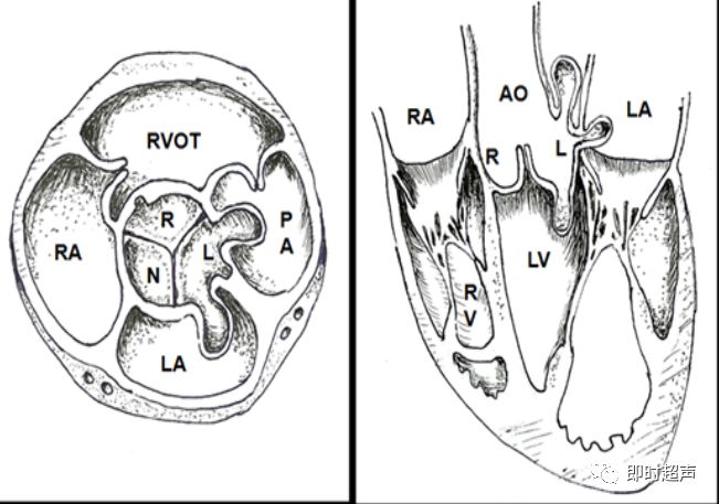 (l:左冠窦; n: 无冠窦; r: 右冠窦)  诊断左冠窦瘤的关键在于判断其