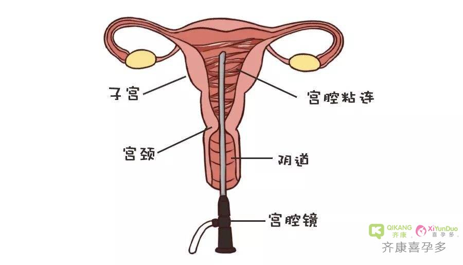 宫腔黏连为什么会导致不孕?宫腔黏连必须要做试管和代孕吗?