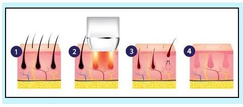 永久脱毛什么原理(2)
