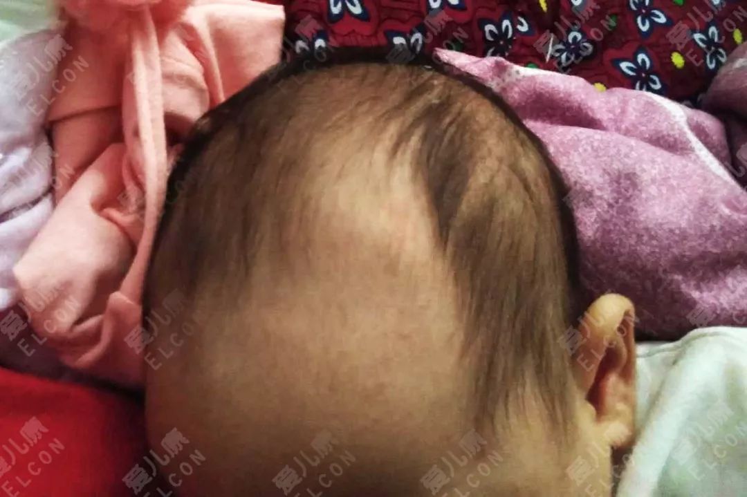                     宝宝频繁掉头发就是缺东西了？医生一句话，说出了婴儿脱发真相…