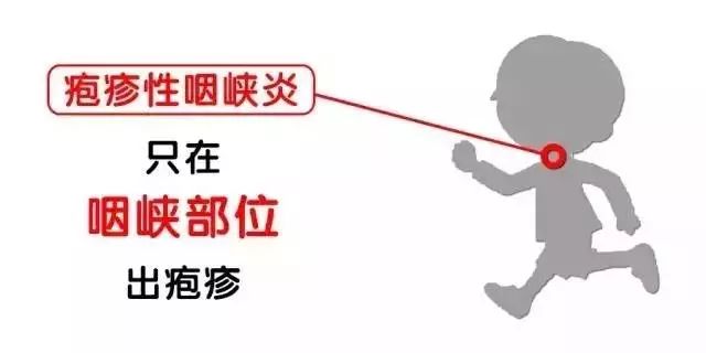                     幼儿园疱疹性咽峡炎进入高发期，这些防护知识家长要知道
