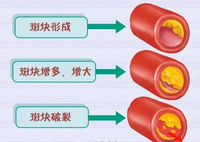 血脂怎么看呢 ef3ce5a6358945b48cbbaa3e41784daf.jpeg