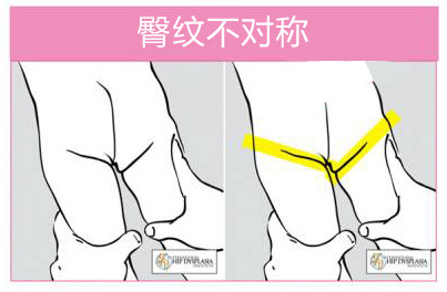 宝宝腿纹不对称,严重的会跛腿!附自查和正确护理