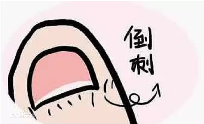                     宝宝手指上出现倒刺？宝妈该注意这点了