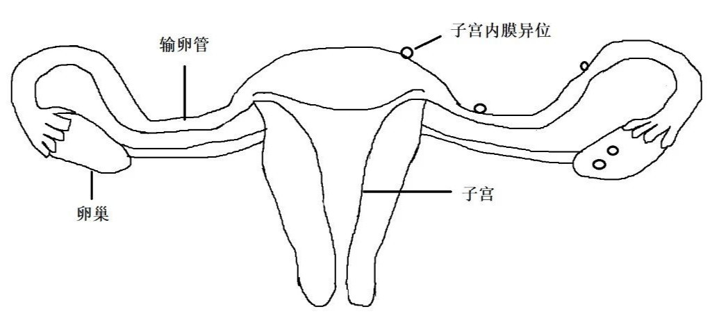 痛经?这病常发生在生育年龄女性中!