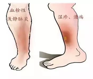 是什么原因引起静脉曲张 37b508ccd9af43ed88733091c64f3814.jpeg