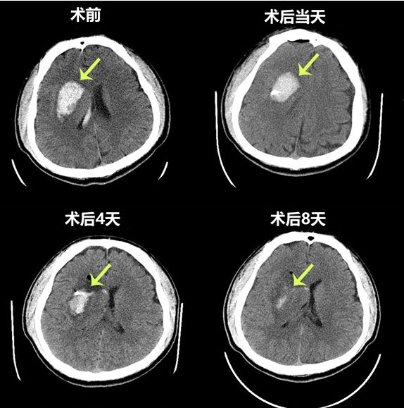 脑出血手术一定要"脑洞大开"吗?