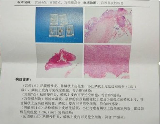 经tct hpv检查,阴道镜检发现可疑细胞后,医生需要做病理切片以进行