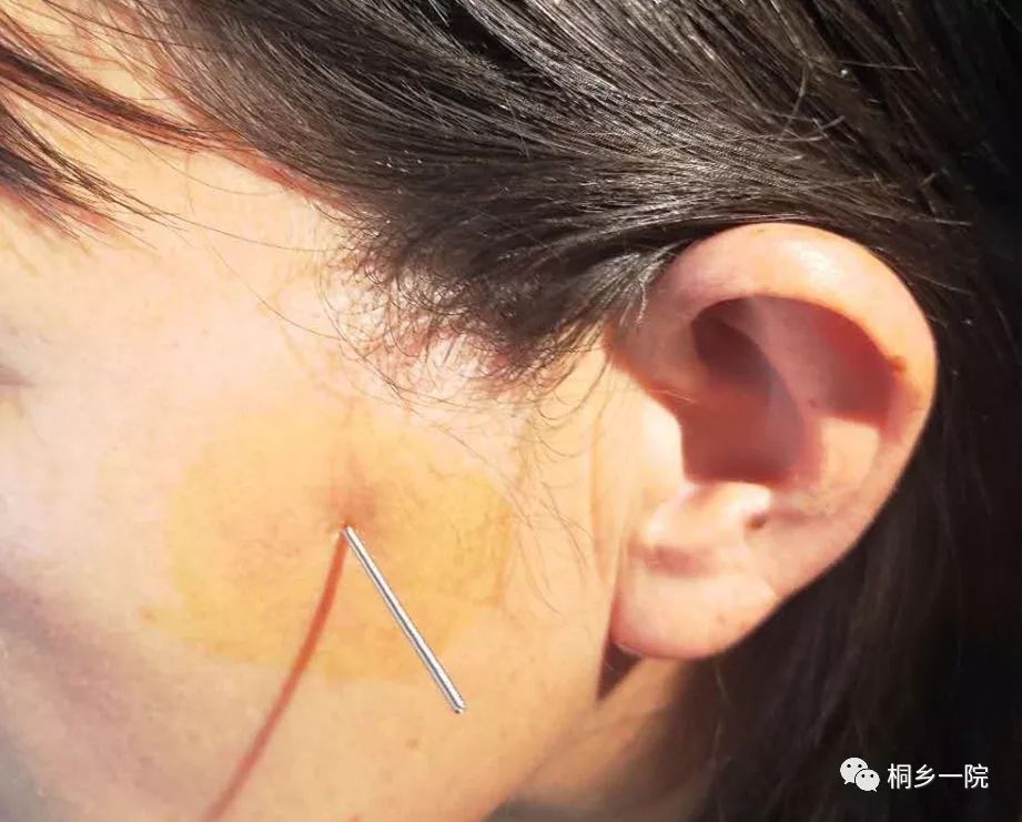 该治疗方法类似于中医的针刺穴位,用的也是中医的针灸针,但其针刺的