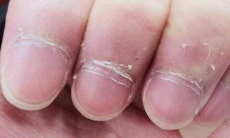                     宝宝有这6种症状，说明缺锌了，缺锌宝宝易生病，爸妈请注意