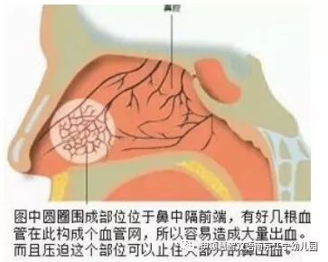 幼儿流鼻血怎么办