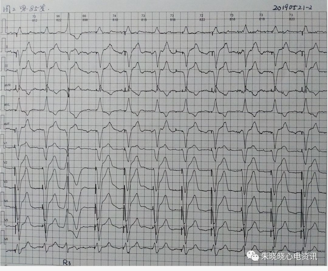 卢老师看心电图-- 房性心动过速并心室起搏心律 2019-5-21
