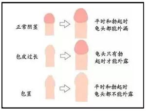 包皮过长,包茎先基本了解下什么是自然容易发生炎症作为藏污纳垢的