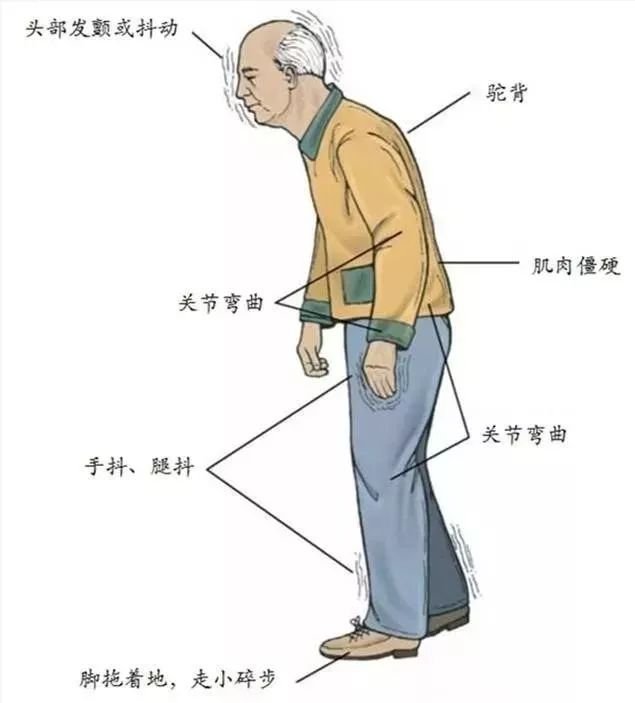 【金秋健康科普】浅谈帕金森
