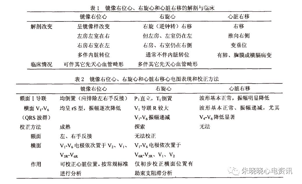 掌握各种类型右位心的心电图表现有助3 者的诊断, 只有校正心脏位置