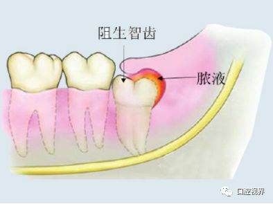 危害一:智齿冠周炎