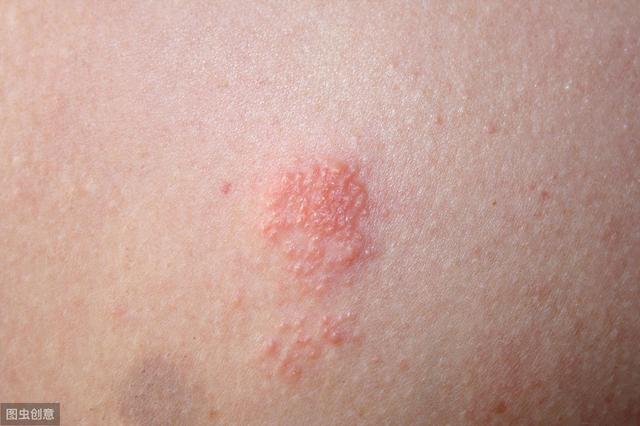 带状疱疹有哪些早期表现当你的皮肤出现这些症状时就需注意了
