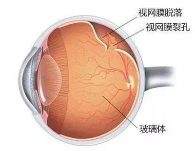 视网膜脱离