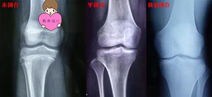                     【紧急！】孩子身上这条线，决定孩子未来的身高