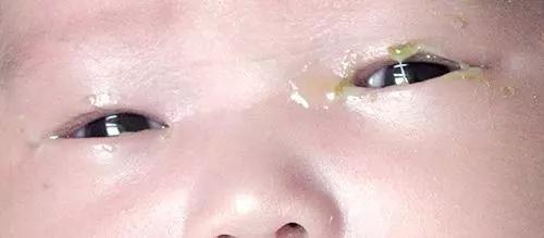                    孩子眼屎多，可能不只是上火！