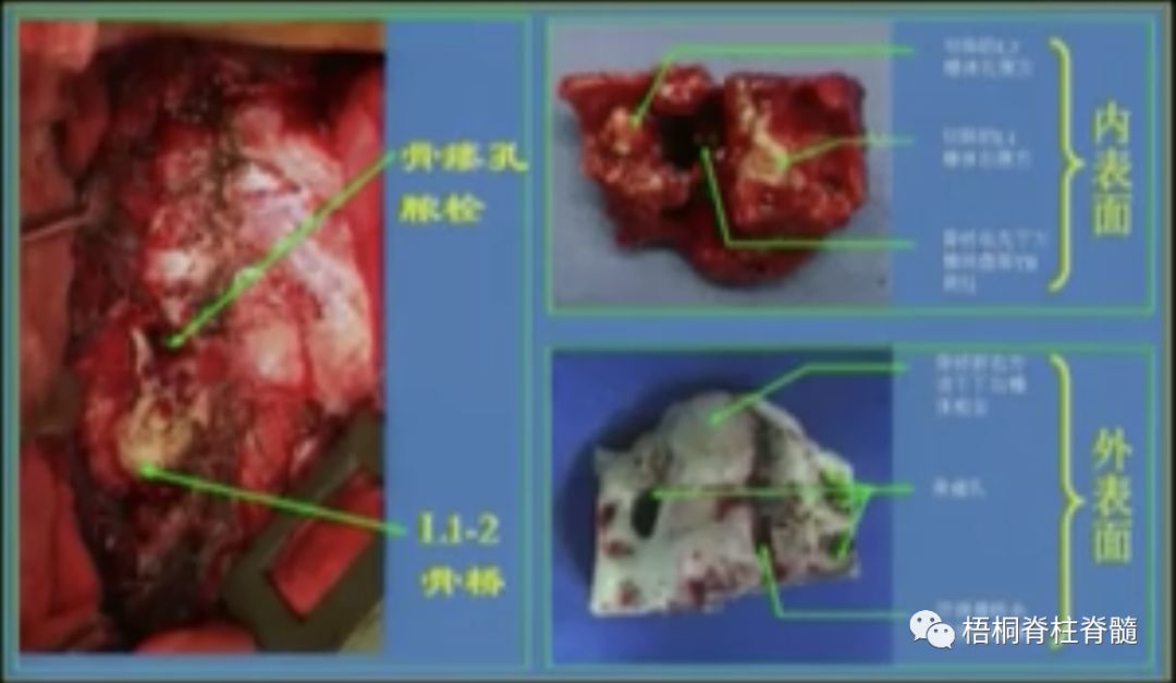 结核杆菌形成坏死的结核冷脓肿压迫邻近组织或形成窦道,或压迫脊髓