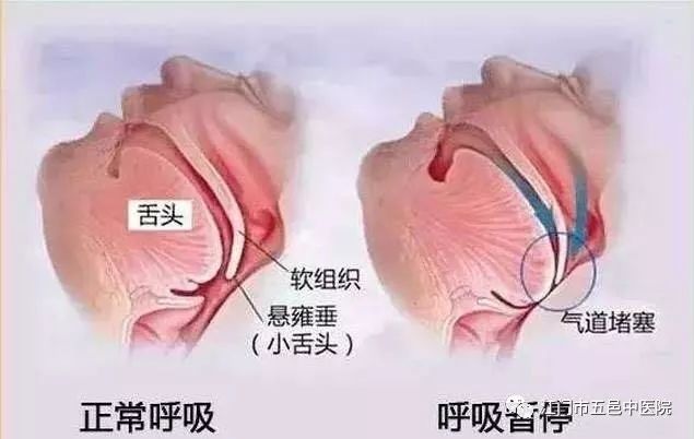 打鼾的原理是什么_打鼾是什么原因导致的