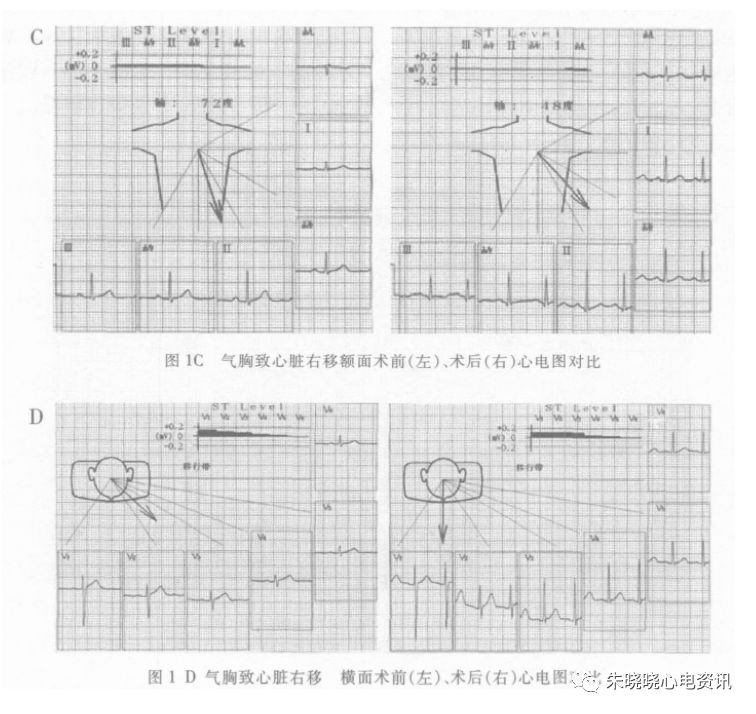 v2 位置描记( 图2b) , 此时v1,v2 呈rs 型, v5,v6 呈宽钝的r 型,心电