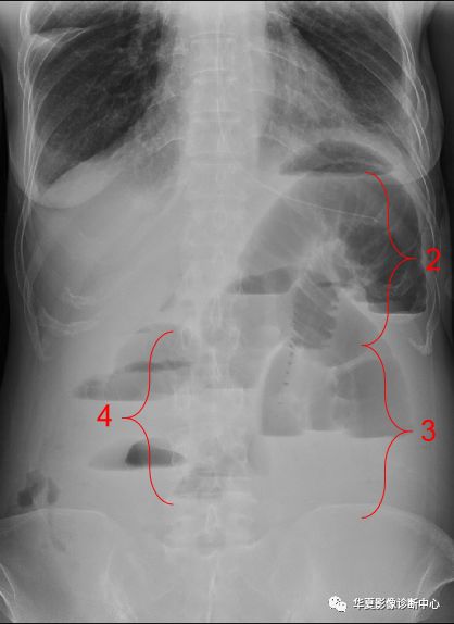胃肠道穿孔:对于胃肠道穿孔的诊断,腹部平片主要是通过看膈下游离气体