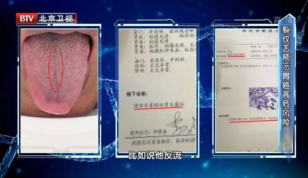 出现3种舌象,多种癌症容易找上门!