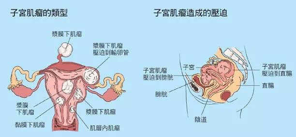 4,白带增多 子宫腔增大,子宫内膜腺体增多,加之盆腔充血,可使白带