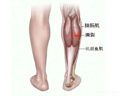 如何减大腿小腿 0ae2144f2d91466fa897cd8328604fa7.jpeg