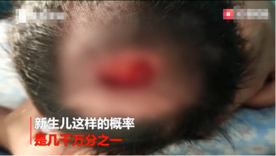                     新生儿被发现患有罕见病，天生头皮少一块，发生率仅为千万分之一