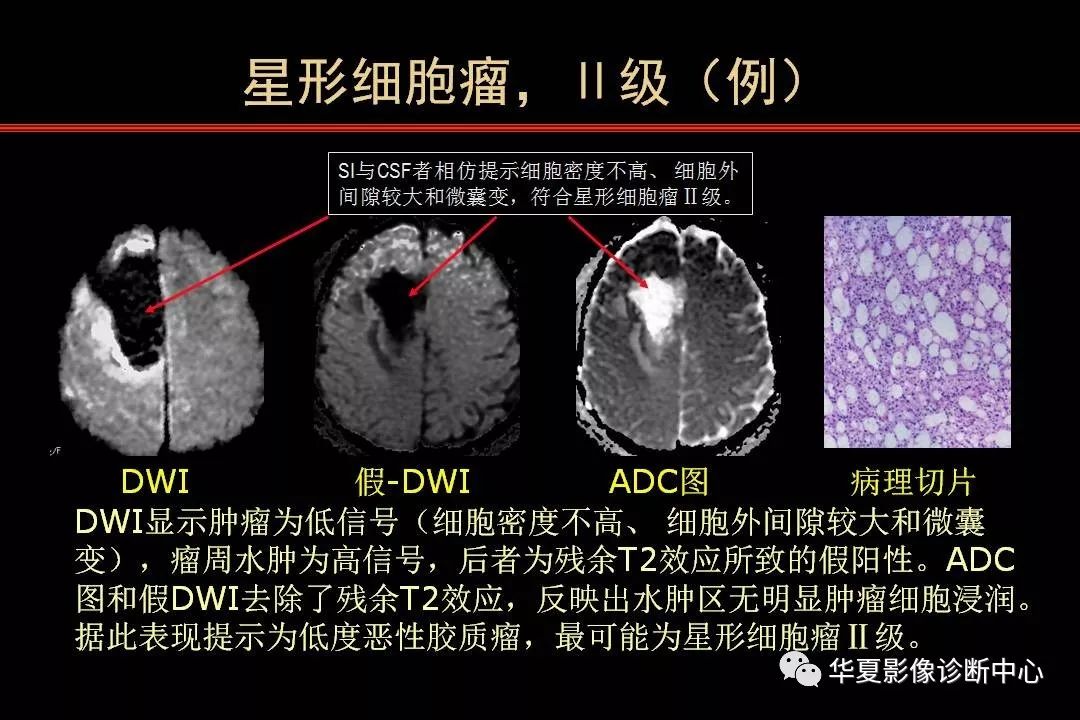 脑肿瘤的mrdwi和dti诊断与鉴别诊断