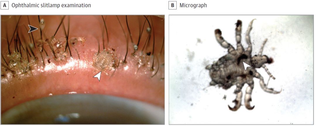 下图(b)示显微镜检查确诊为眼睑阴虱感染