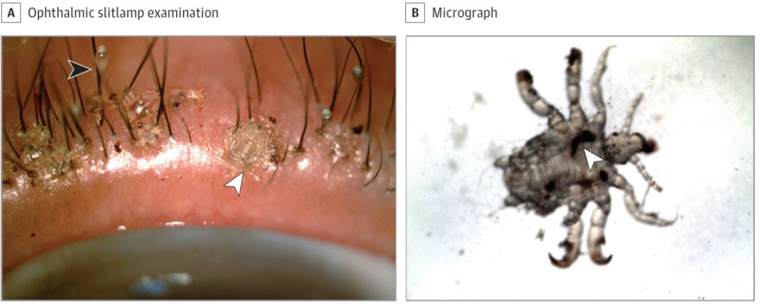 确诊为眼睑阴虱感染,受累睫毛予以拔除,黄降汞软膏治疗两周后病情好转