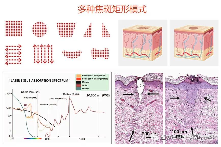 科普二氧化碳点阵激光