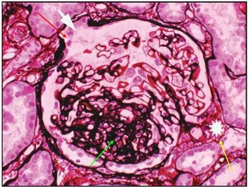 肾内病理图解 局灶节段性肾小球硬化_细胞
