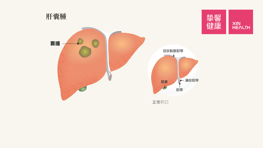 大多数肝囊肿患者无明显症状,仅在体检中偶然发现.