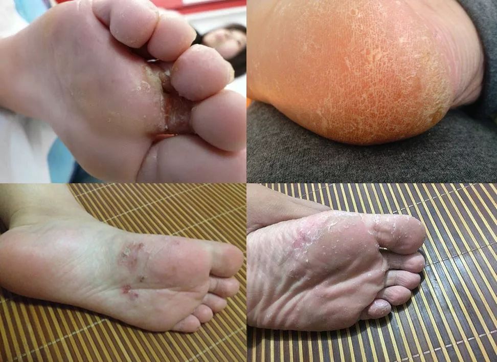 尤其是脚底和脚趾缝里, 仿佛小虫子在不停的撕咬, 总的来说,脚臭和脚