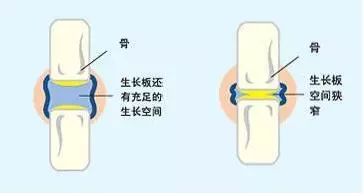 别被遗传吓倒!挖掘孩子长高潜力,请抓住生长黄金期