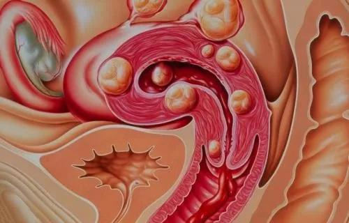 子宫肌瘤需要手术吗 一般来说,子宫肌瘤超过5cm则表示病情比较严重