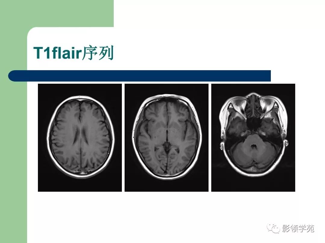 【经典】磁共振临床应用——脑实质篇