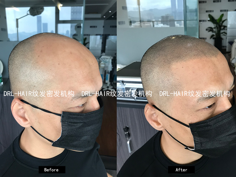 drl-hair|最新smp 3d纹发技术,为脱发患者打开新世界大门