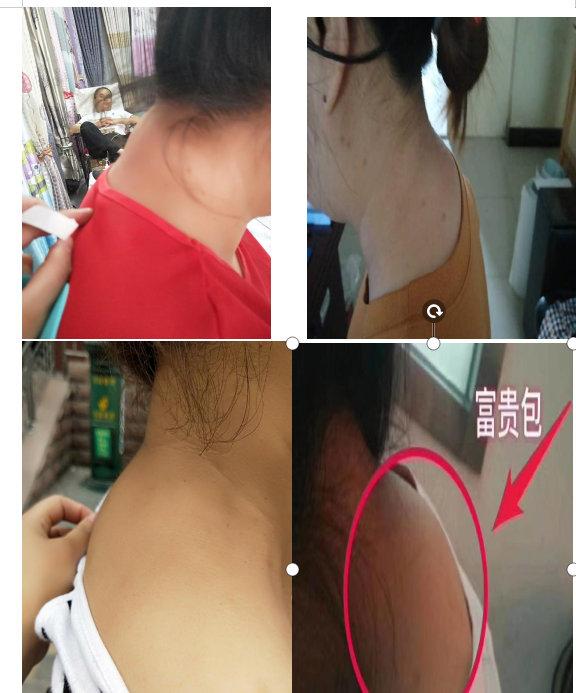 宫廷正骨何文峻老师带您了解如何快速治疗富贵包