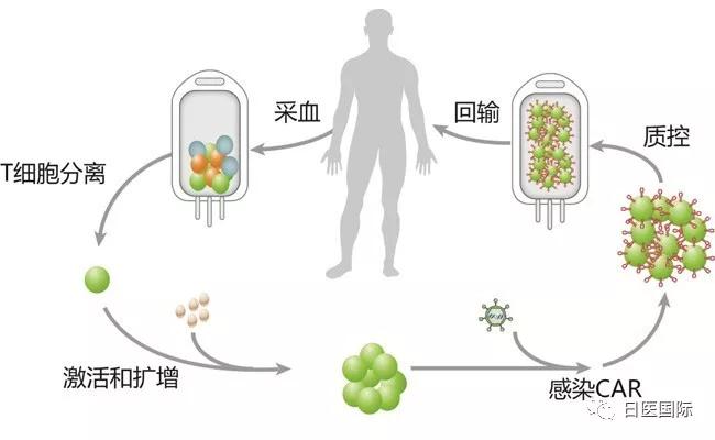 日本CAR-T细胞疗法获批上市，定价高昂或将纳入日本医保！ 