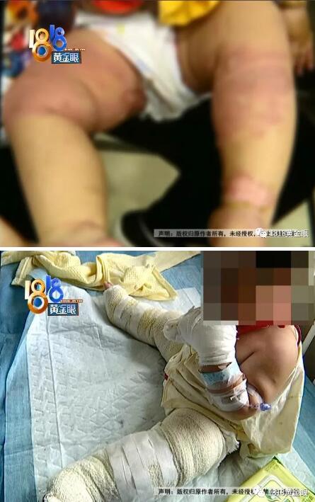                     一家人去下馆子，宝宝被水烫了，多处二度烫伤