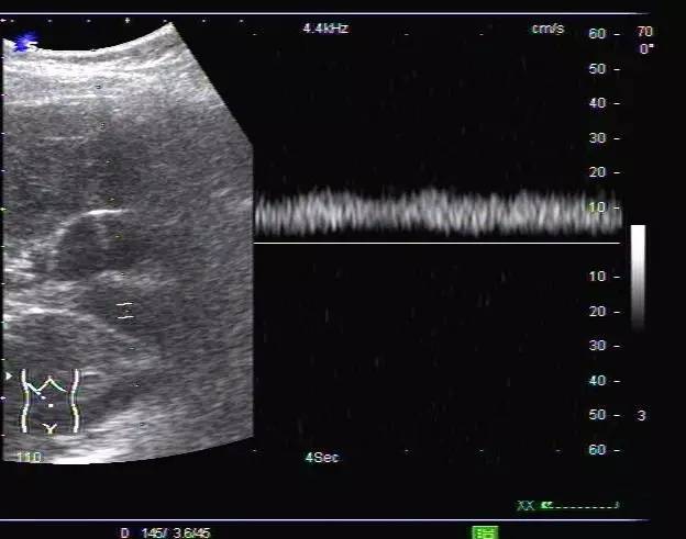 超声新手福利:门静脉海绵样变