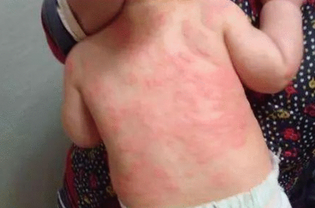                     夏天宝宝得渗出性“湿性湿疹”, 宝妈万分焦虑, 1招根除湿疹